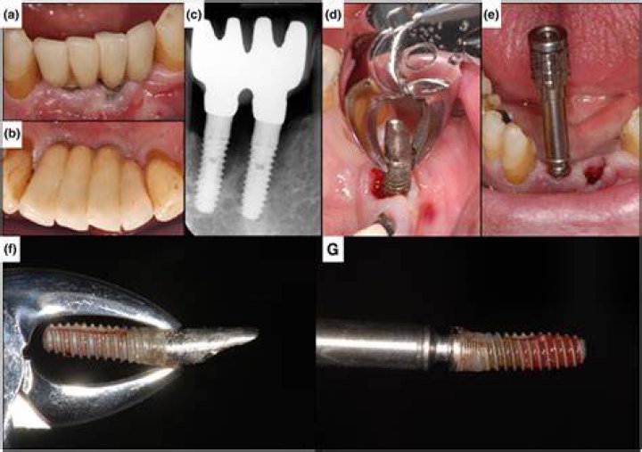 How are failed dental implants removed?