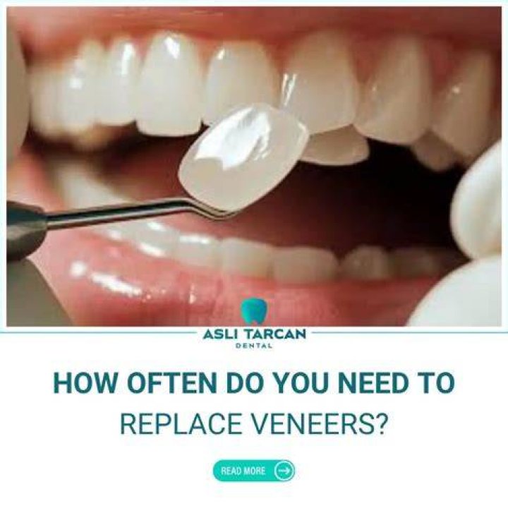 How often do veneers chip?