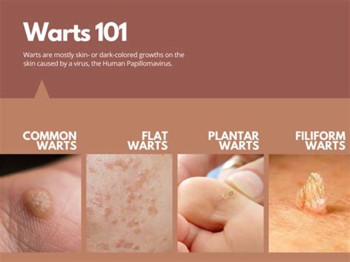 What does it mean when a wart hurts?