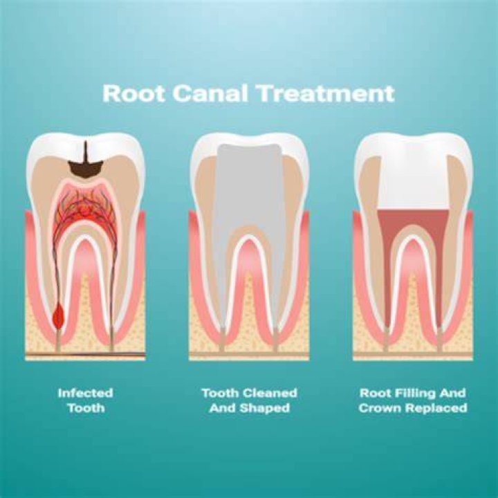 When is a root canal not needed?